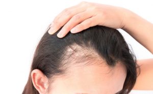 menopause hair loss medication